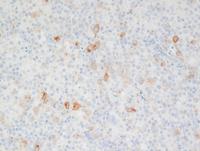 CD30 immunostain in AITL