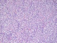 Angioimmunoblastic T-cell lymphoma