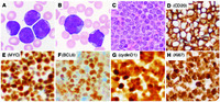 Triple-hit blastoid mantle cell lymphoma presenting like acute leukemia