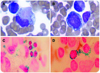 An infant with Pearson syndrome: a rare cause of congenital sideroblastic anemia and bone marrow failure