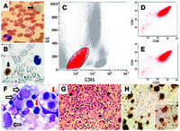 CD34 megakaryocytes and megakaryocytic fragments in myelodysplastic syndrome