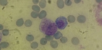 Faggot cell (Leukemic promyelocyte)