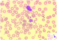 Giant granule and platelets...