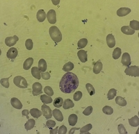 Hypersegmented neutrophil