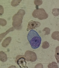 plasma cell leukemia 1