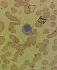 plasma cell leukemia 2
