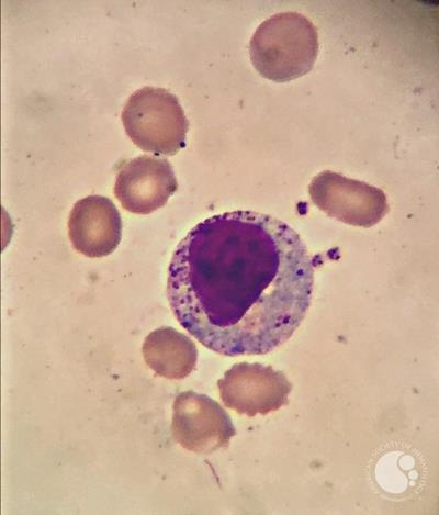 Large Granular Lymphocyte