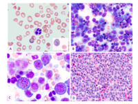 megaloblastic anemia peripheral smear