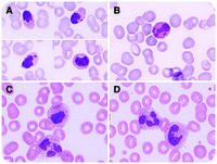 Reversible granulocyte abnormalities after accidental ingestion of Colchicum autumnale