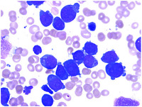 Most Common Leukemia In Down Syndrome