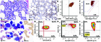 Diagnosing therapy-related acute myeloid leukemia with 8% blasts in bone marrow with concomitant plasma cell myeloma