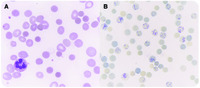 A rare case of autoimmune hemolytic anemia