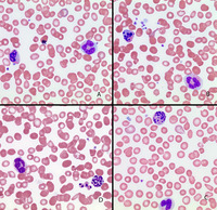 Apoptotic neutrophil in peripheral blood of a patient with myelodysplastic syndrome (MDS)