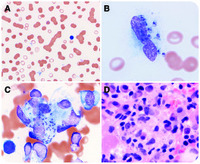 Peripheral blood and bone marrow involvement by visceral leishmaniasis