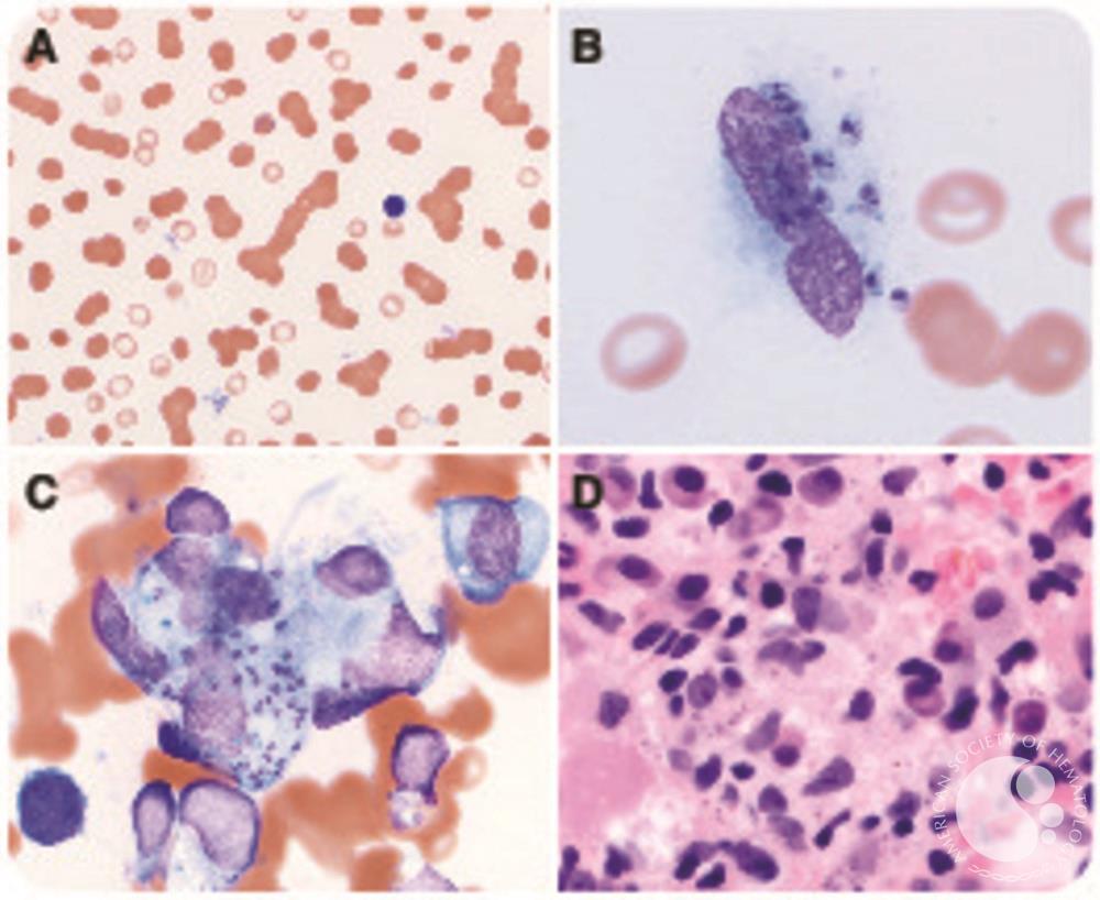 Peripheral blood and bone marrow involvement by visceral leishmaniasis