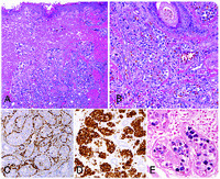 Intravascular large cell lymphoma of NK/T-cell type, EBV positive