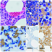 Intracellular light chain crystals in myeloma