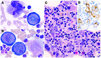 Red cheeks to red cell aplasia: parvovirus B19 in a heart transplant patient