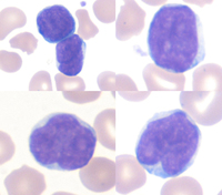what are atypical lymphocytes
