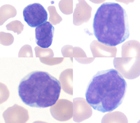 pediatric-lymphocytes