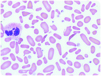 sickle-cell-trait-with-thalassemia-elliptocytosis-and-thrombocytosis