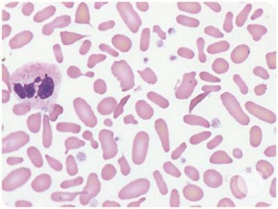 Sickle cell trait with β-thalassemia, elliptocytosis, and thrombocytosis