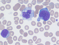 Infectious Mononucleosis Blood Smear