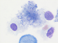 Pneumocystis in BAL