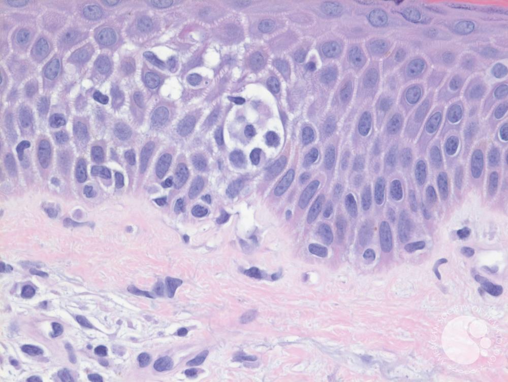 Mycosis Fungoides 1