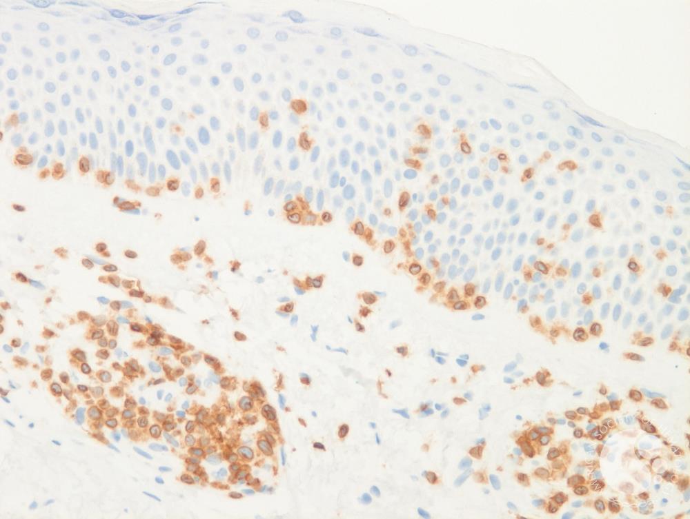Mycosis Fungoides 2