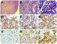 Exuberant nodal proliferation of mature plasmacytoid dendritic cells in a patient with chronic myelomonocytic leukemia