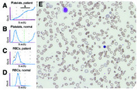 Red cell fragments can mask severe thrombocytopenia