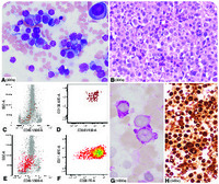 “Hof” in pronormoblasts: pure erythroid leukemia mimicking plasma cell myeloma