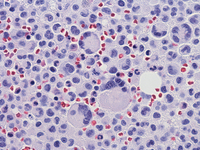 Mast cell Leukemia