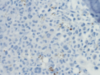 CD25 IHC