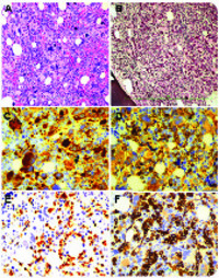 AML with myelodysplasia-related changes masquerades as acute panmyelosis with myelofibrosis