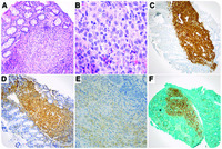 Incidental Langerhans cell histiocytosis of the colon with BRAF p.V600E mutation