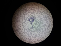 Microfilaria seen in same case in peripheral blood smear.