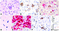 Classical Hodgkin lymphoma arising in a patient with chronic lymphocytic leukemia (Richter syndrome)