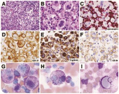 Aleukemic mast cell leukemia associated with chronic myelomonocytic leukemia and chronic lymphocytic leukemia