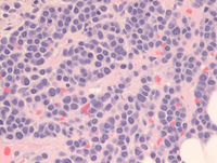 Plasmacytoma