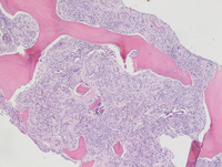Neuroblastoma cells in marrow -1