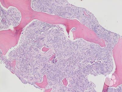 Neuroblastoma cells in marrow -1