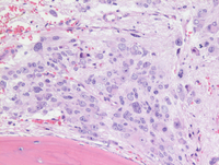 Neuroblastoma cells in marrow -2