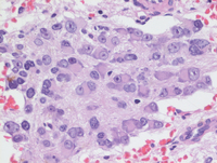 Neuroblastoma cells in marrow -3