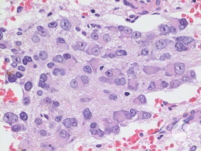 Neuroblastoma cells in marrow -3