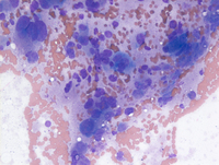 Neuroblastoma cells in marrow -4