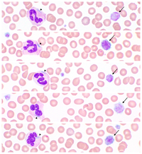 Macrothrombocytopenia and neutrophils with Döhle-like bodies