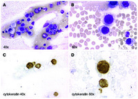 Carcinocythemia (carcinoma cell leukemia)