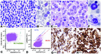 “Soccer ball” cells to “donut” cells: an unusual case of Richter syndrome